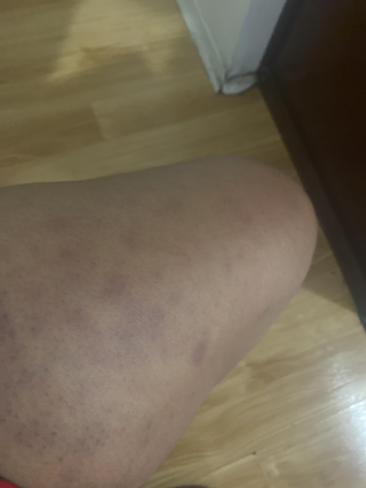 TESMED Cellulite Manual Massager Roller for Thighs and Buttocks | Made in Italy and patented, with converging and diverging roller technology for targeted anti-cellulite massage. customer photo 2