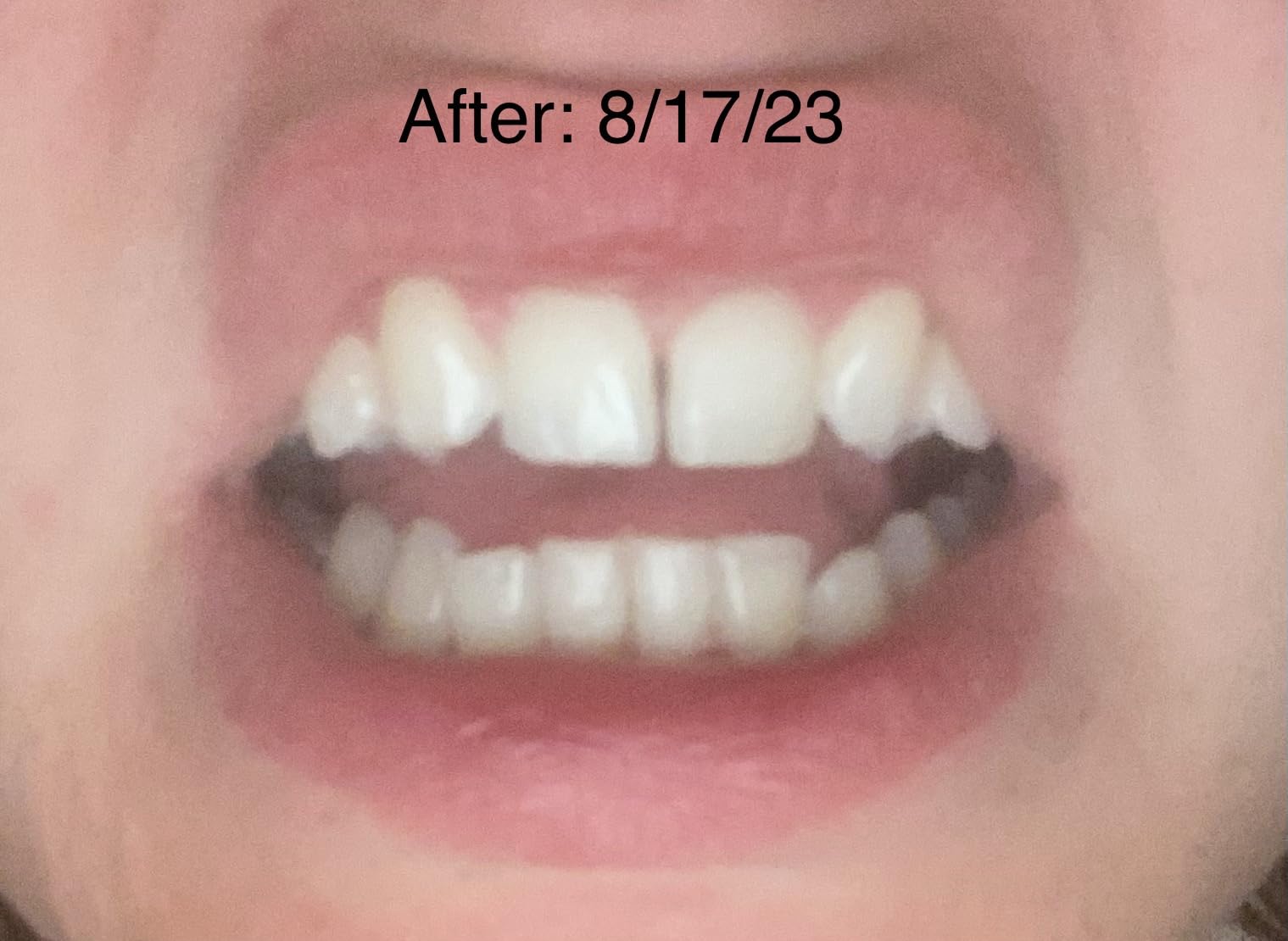 Pdoo Teeth Whitening Kit with LED Light for Sensitive Teeth, Fast Results for Brightening at Home, Teeth Whitening Gel Helps Remove All Kinds of Stains customer photo 2