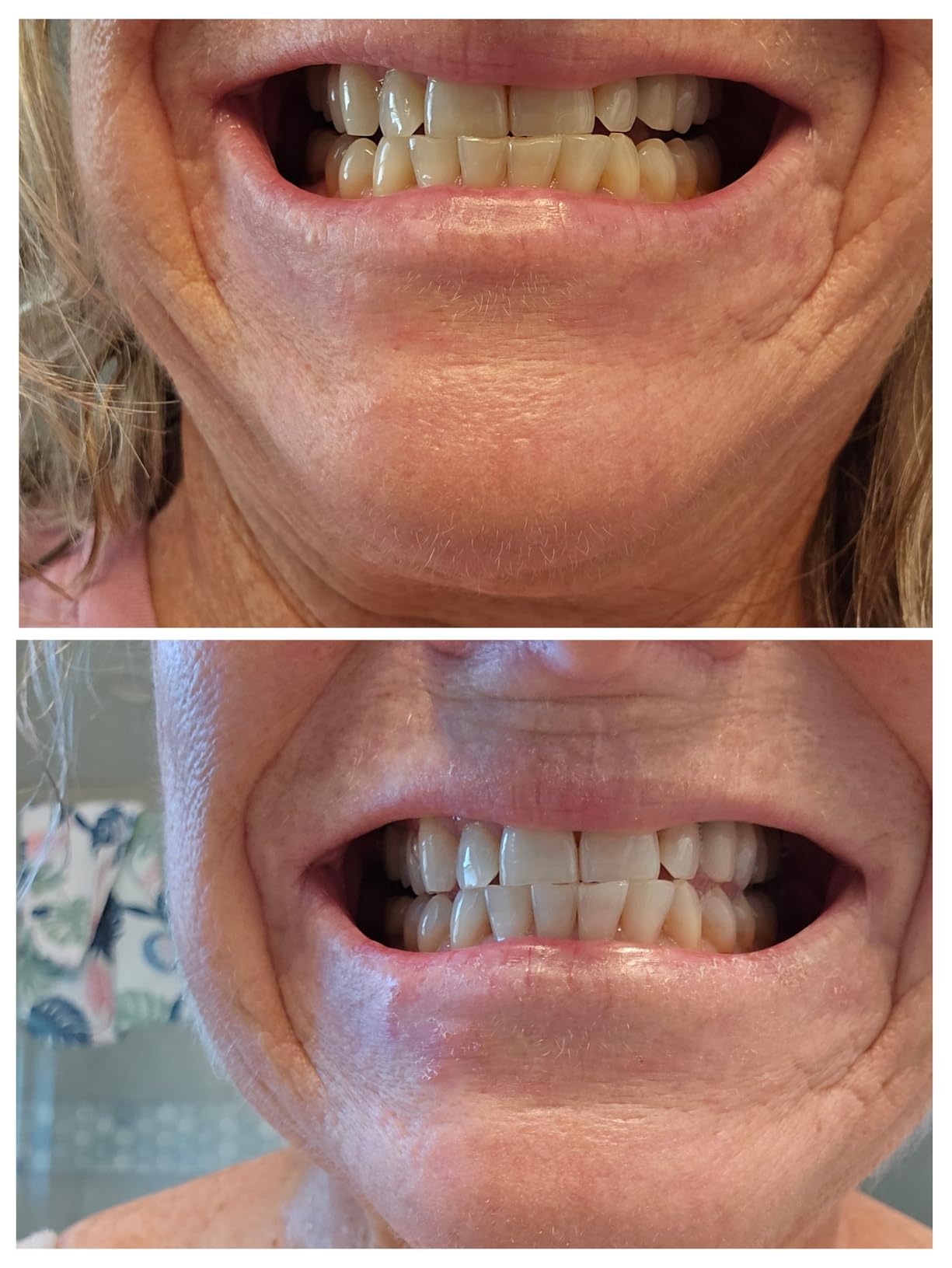 Opalescence GO 15 Teeth Whitening Trays Bundle 15% Hydrogen Peroxide 5194-T | Gel Prefilled Trays - Includes 2Chill Toothbrush Made by Ultradent Products USA. Teeth Whitening Kit -Mint - (10 Treatments) customer photo 2