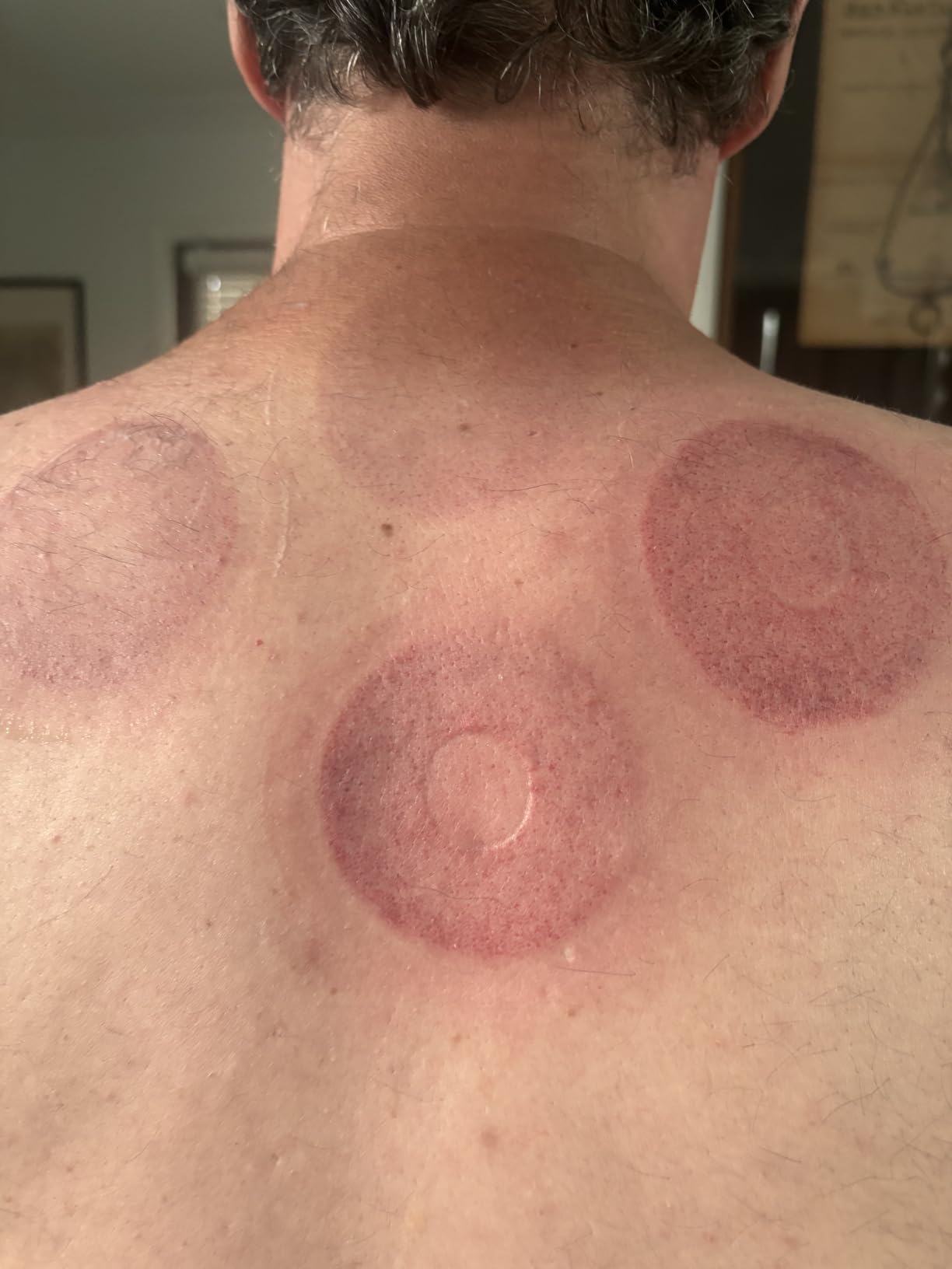REVO The Original 4-in-1 Smart Cupping Therapy Massager, Red Light Therapy for Targeted Pain Relief, Knots, Aches, Muscle Soreness, Circulation & Tighter Skin, Portable Cupping Kit (Four Pack) customer photo 2