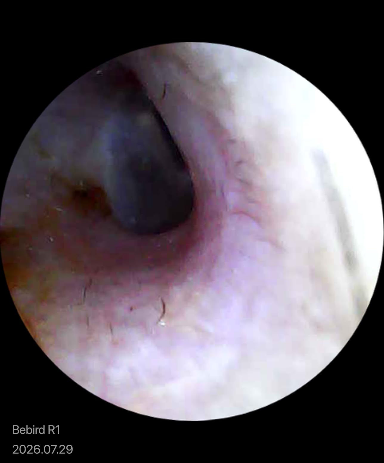 BEBIRD R1 Ear Wax Removal Tool: Ear Cleaner with HD Ear Camera FSA&HSA customer photo 1