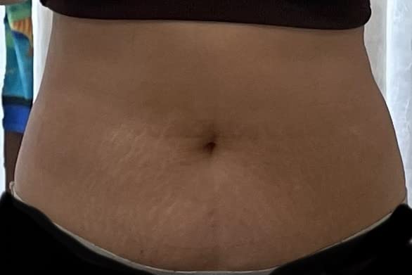 LIPO-Light Machine Body Shaper Weight Loss Fat Reduction Burning Fat Remove Fat Dissolve Beauty Machine customer photo 1